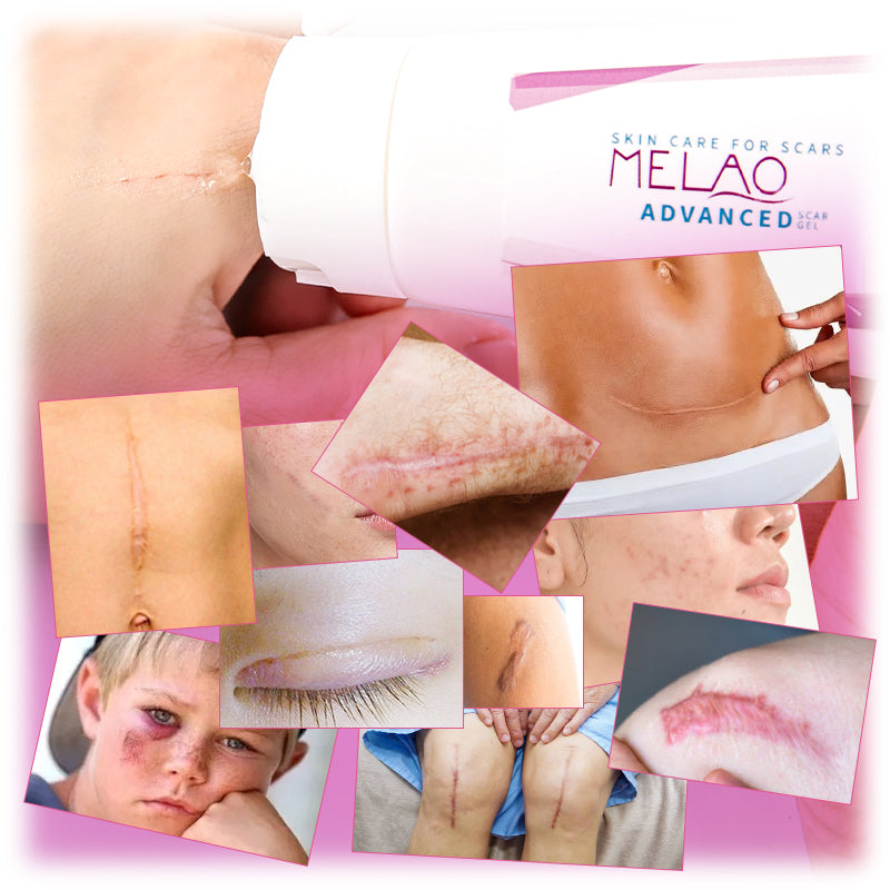 MELAO Scar Removal Gel for Stretch Marks and Acne Repair